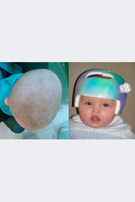 Centro Ortopédico Marvá niño con casco